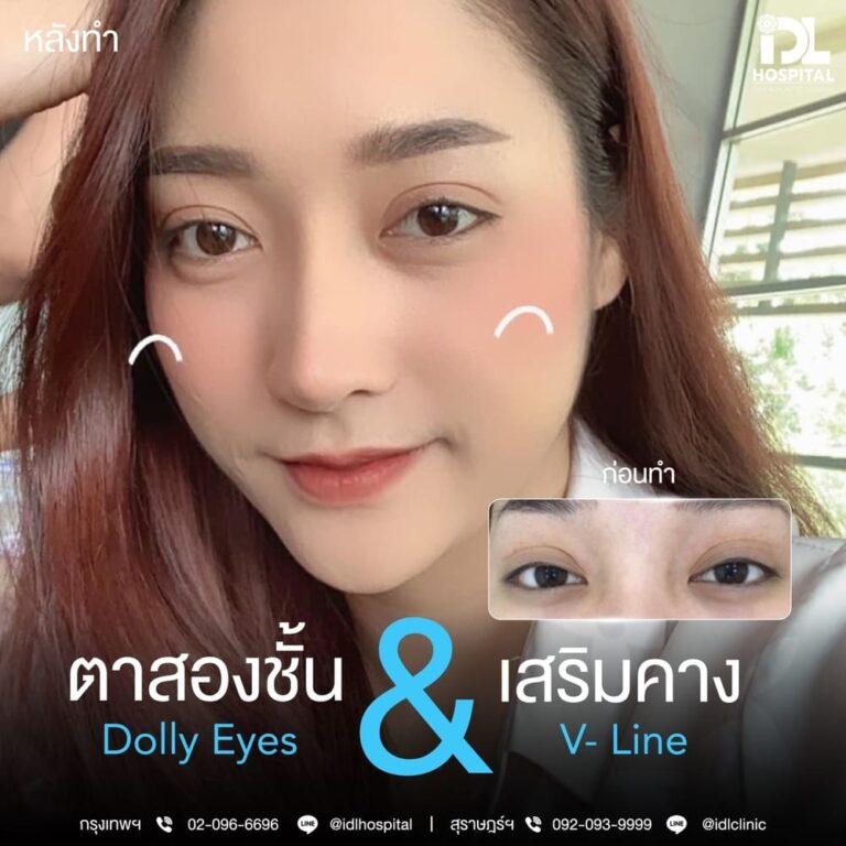 ตาสองชั้น Dolly Eyes เสริมคาง
