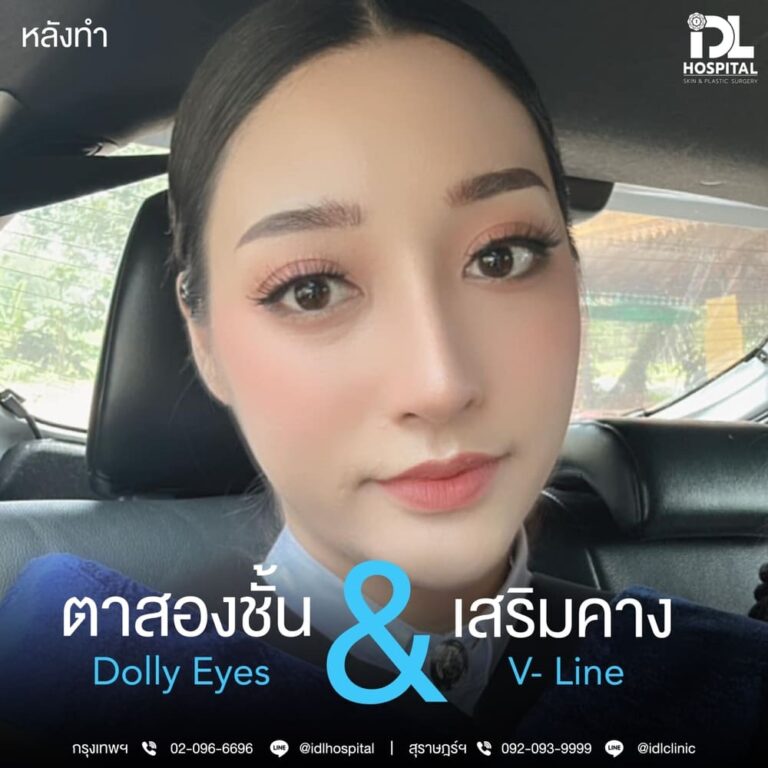 ตาสองชั้น Dolly Eyes เสริมคาง