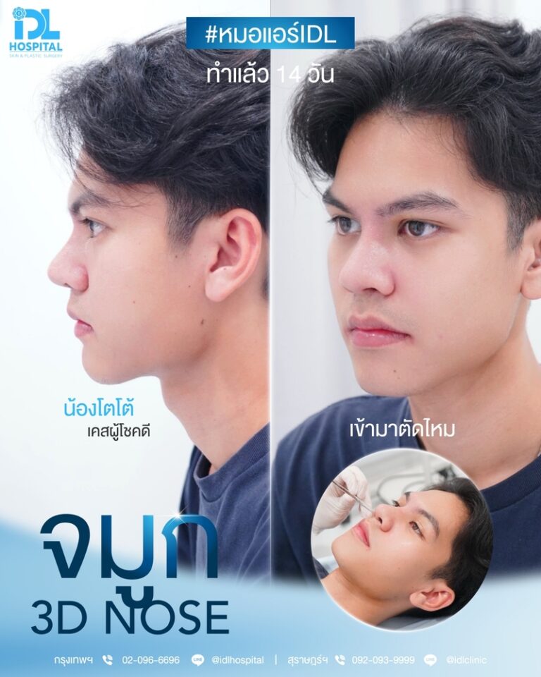 เสริมจมูกผู้ชายกับ