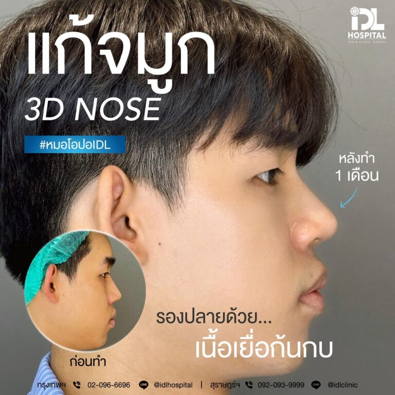 เสริมจมูกผู้ชายกับ