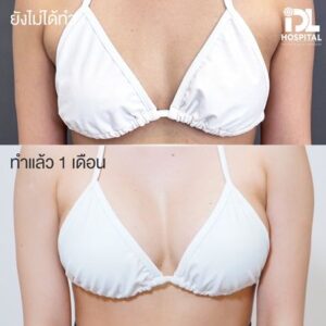 เสริมหน้าอก