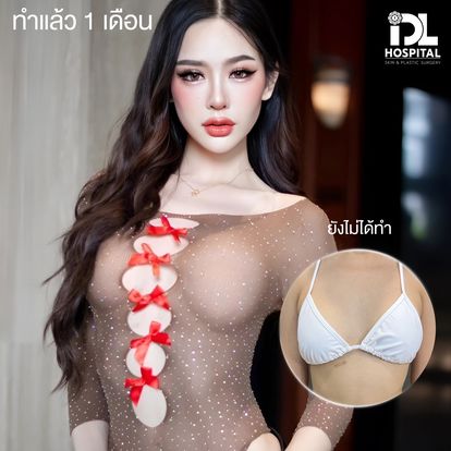 รีวิว เสริมหน้าอก
