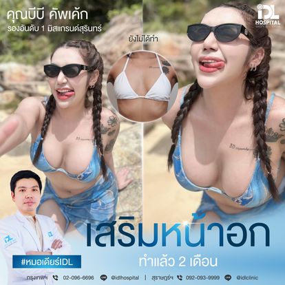 เสริมหน้าอก