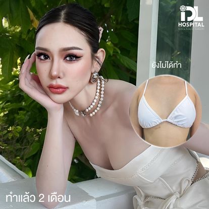 เสริมหน้าอก