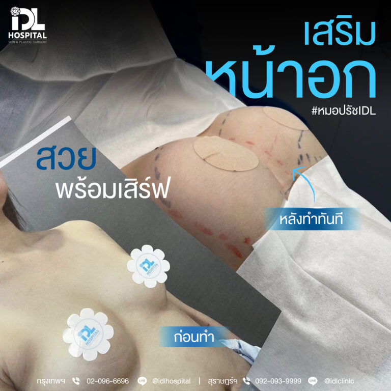 รีวิว เสริมหน้าอก