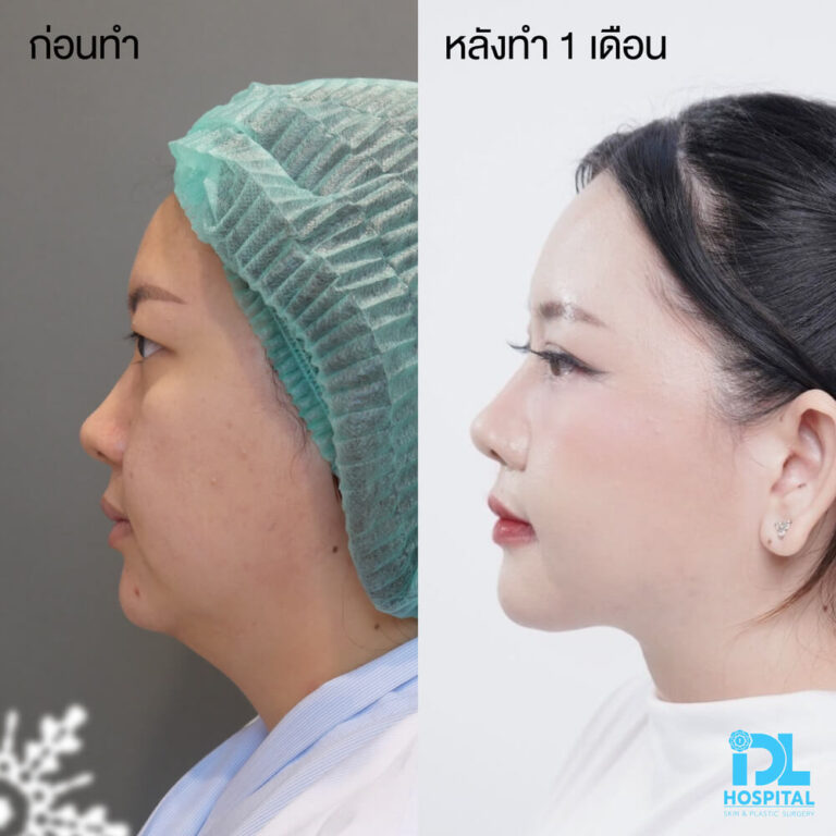 ตัดเหนียง