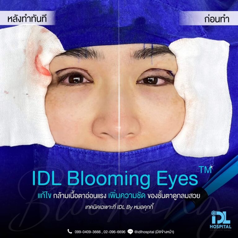 ตาสองชั้น Bloomimg Eyes