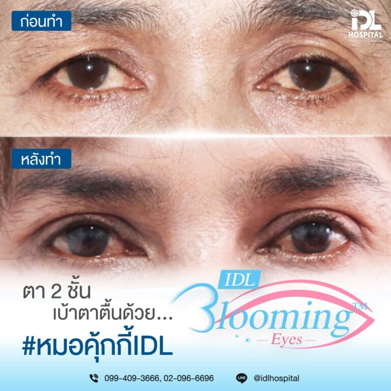 ตาสองชั้น Bloomimg Eyes