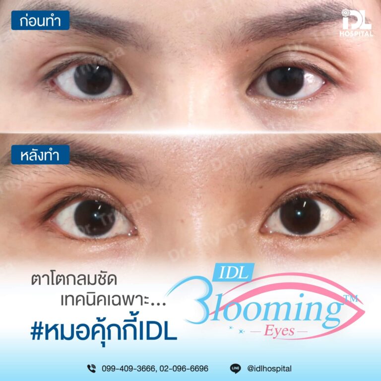 ตาสองชั้น Bloomimg Eyes