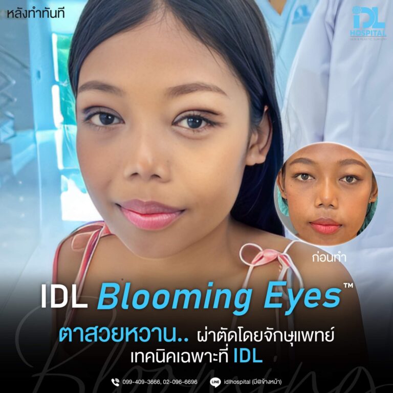 ตาสองชั้น Bloomimg Eyes