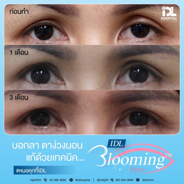 ตาสองชั้น Bloomimg Eyes