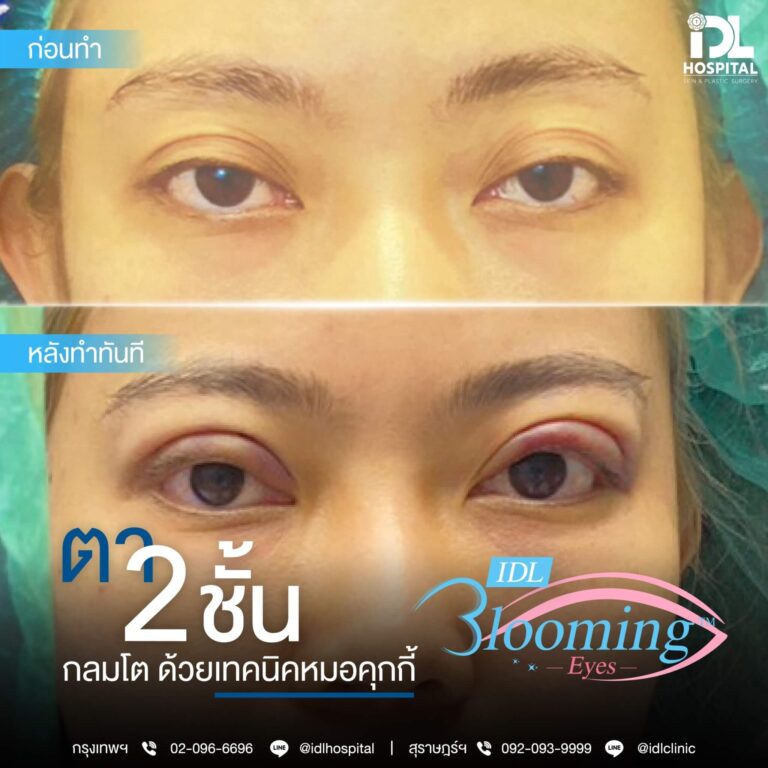 ตาสองชั้น Bloomimg Eyes