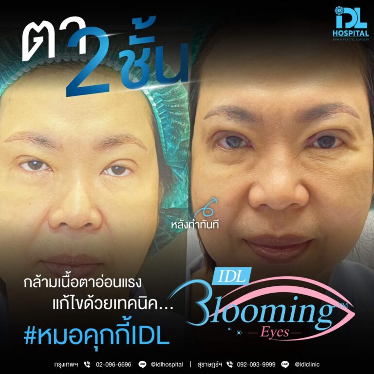 ตาสองชั้น Bloomimg Eyes