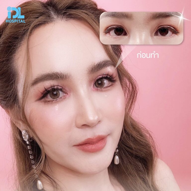 ตาสองชั้น Bloomimg Eyes