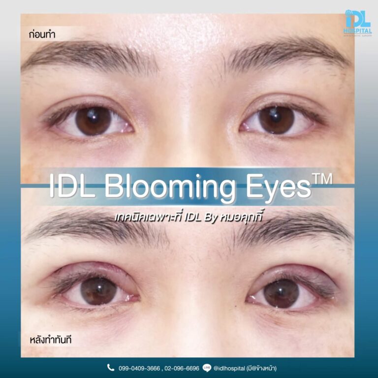 ตาสองชั้น Bloomimg Eyes