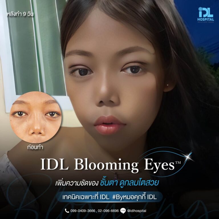 ตาสองชั้น Bloomimg Eyes
