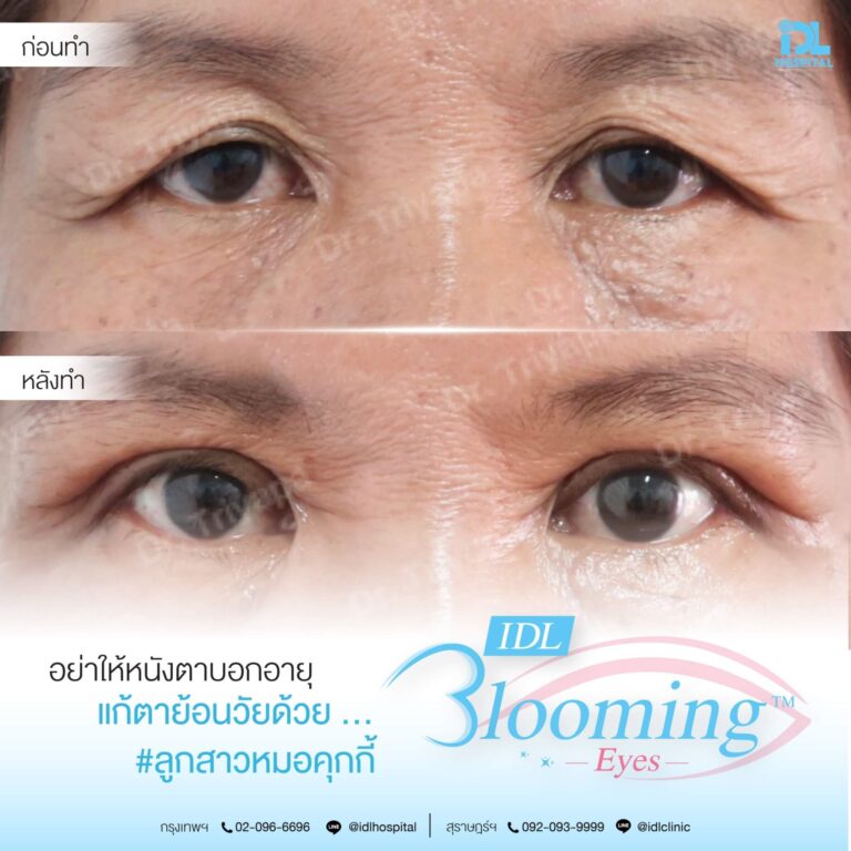 ตาสองชั้น Bloomimg Eyes