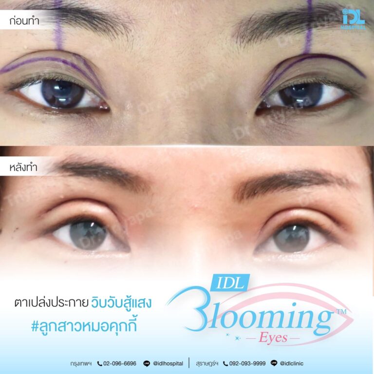 ตาสองชั้น Bloomimg Eyes