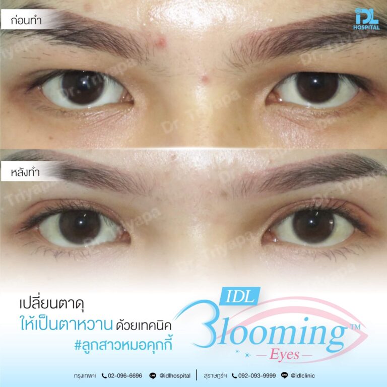 ตาสองชั้น Bloomimg Eyes