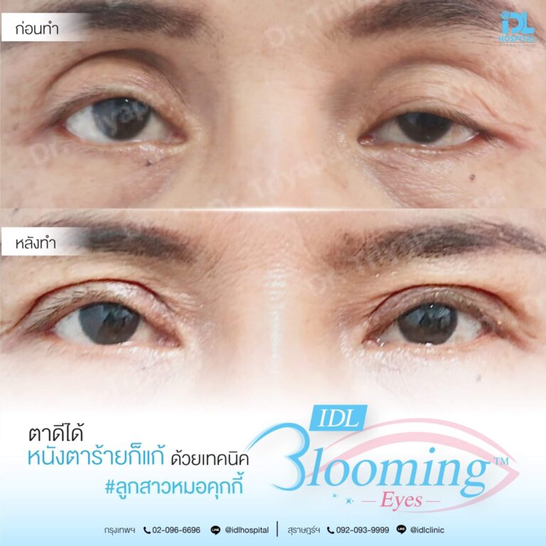 ตาสองชั้น Bloomimg Eyes