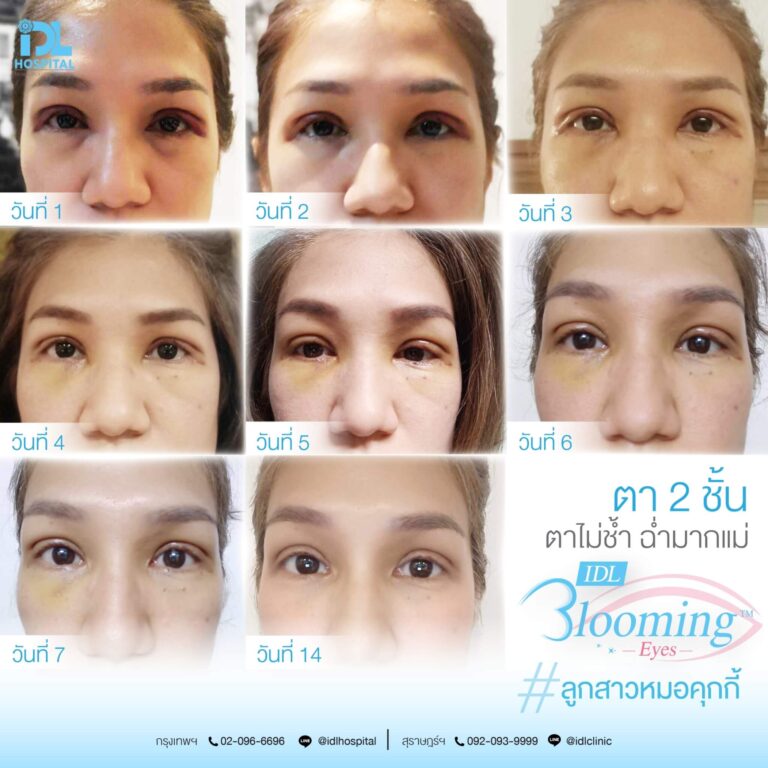 ตาสองชั้น Bloomimg Eyes