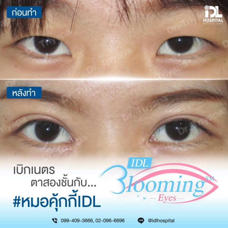 ตาสองชั้น Bloomimg Eyes