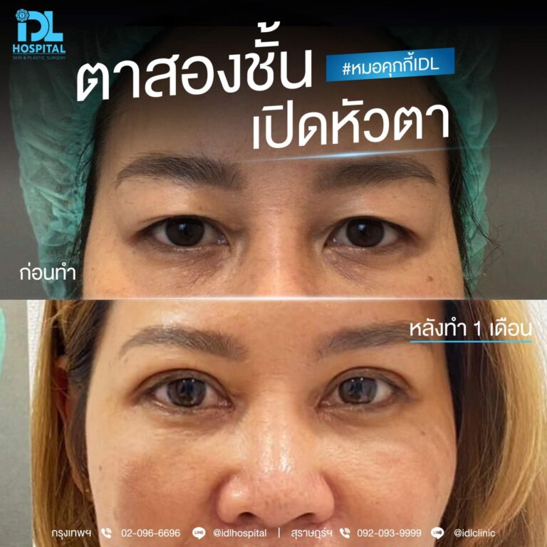 ตาสองชั้น Bloomimg Eyes