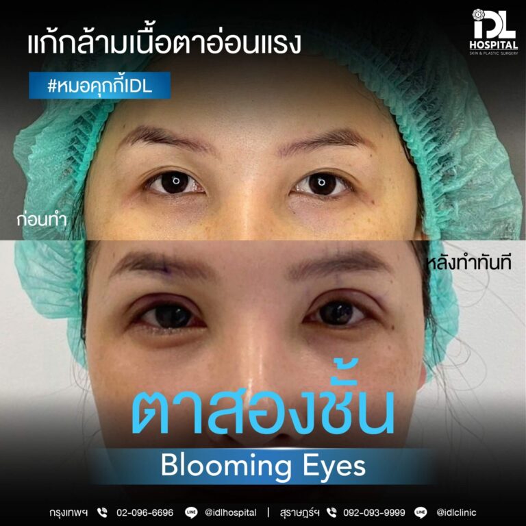 ตาสองชั้น Bloomimg Eyes