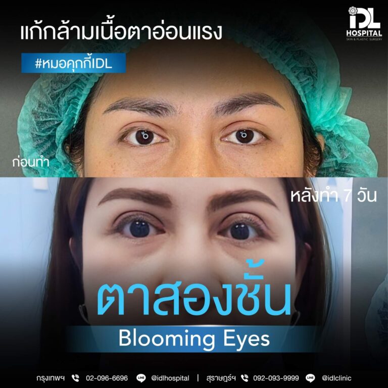 ตาสองชั้น Bloomimg Eyes