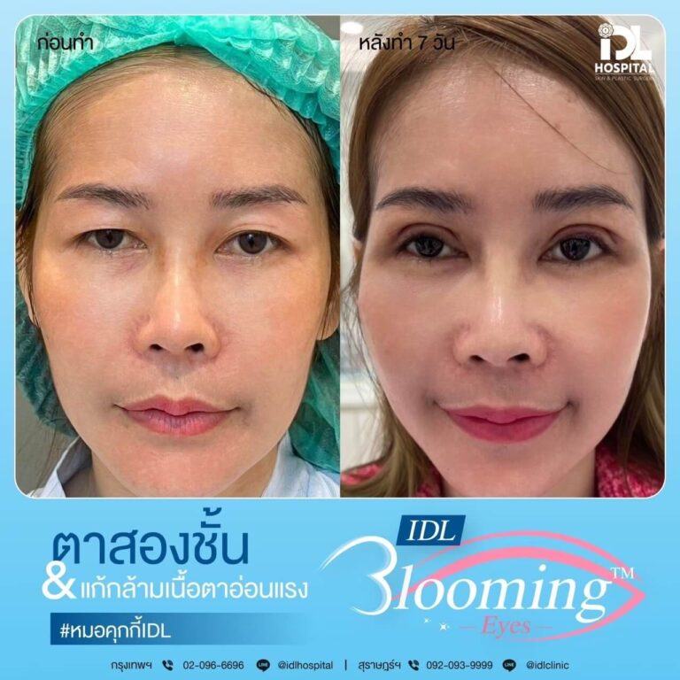 ตาสองชั้น Bloomimg Eyes