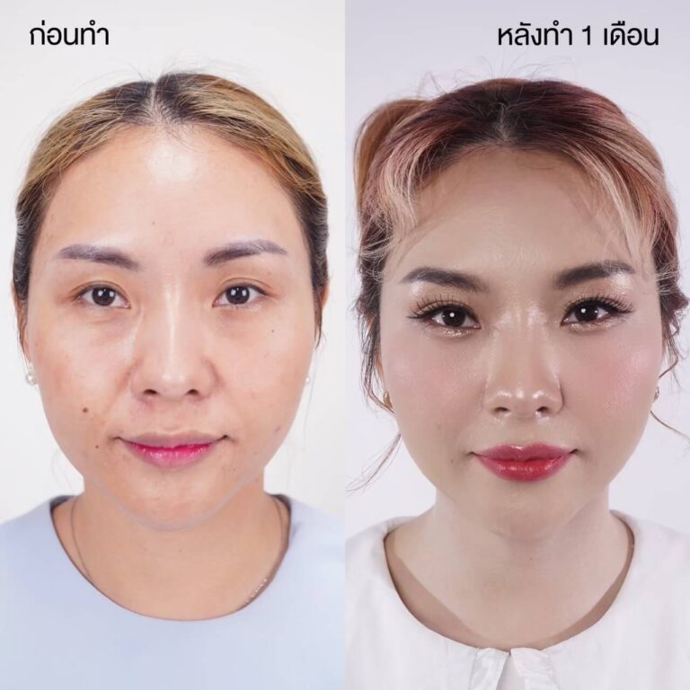 ตาสองชั้น Bloomimg Eyes