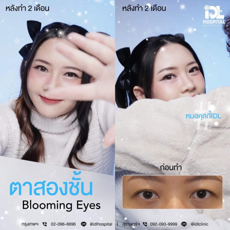 ตาสองชั้น Bloomimg Eyes