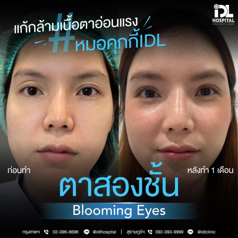 ตาสองชั้น Bloomimg Eyes