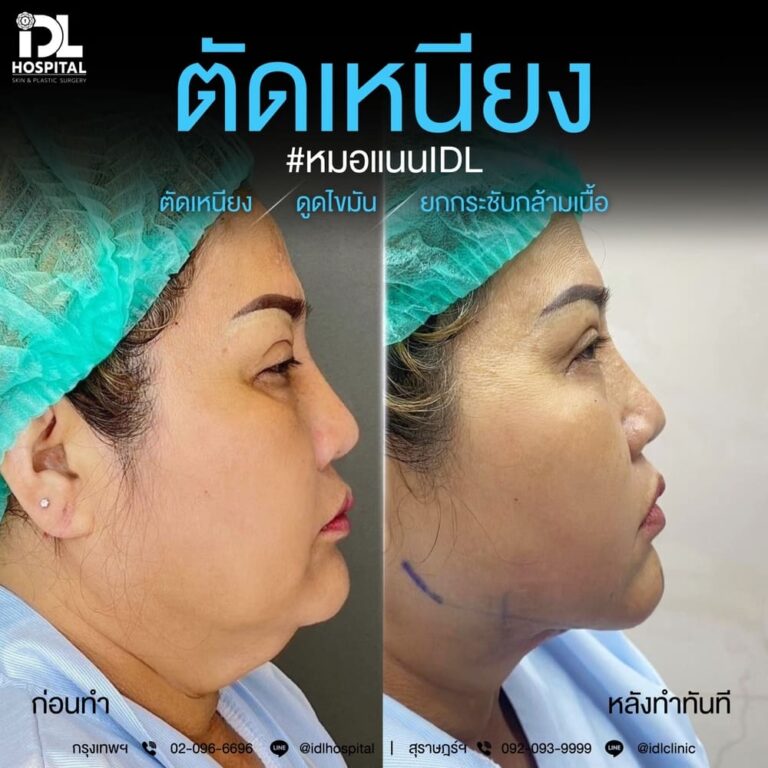 ตัดเหนียง IDL