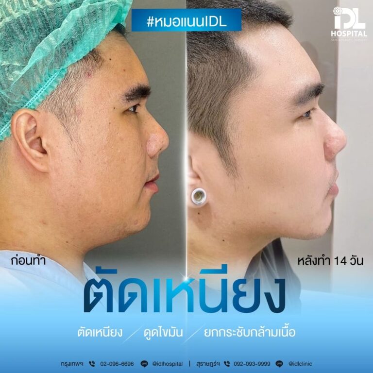 ตัดเหนียง IDL