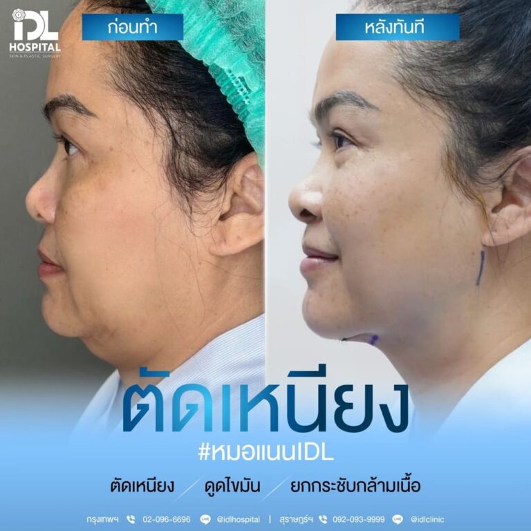 ตัดเหนียง IDL