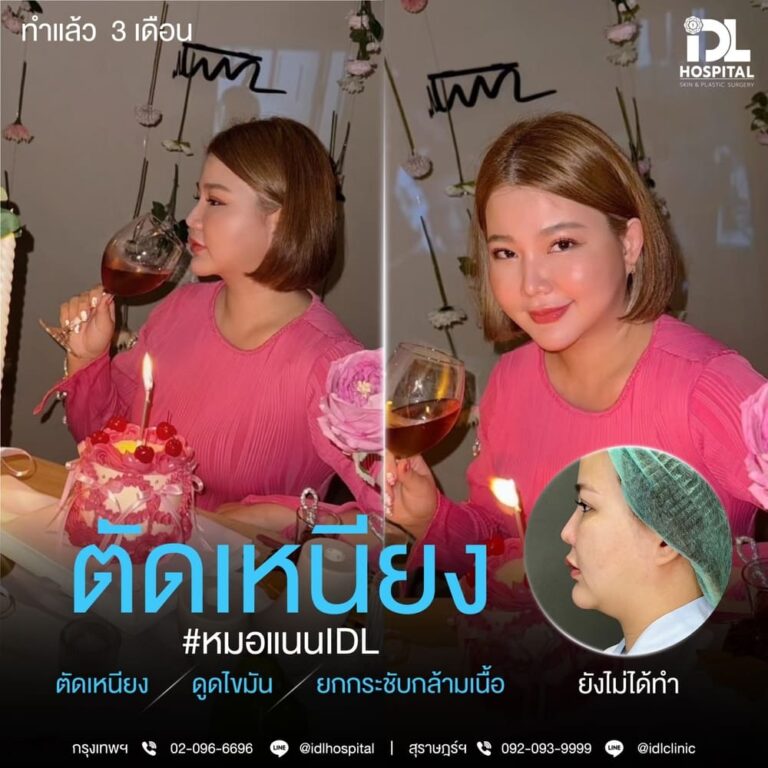 ตัดเหนียง IDL
