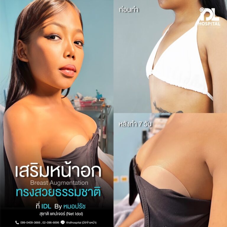 รีวิว เสริมหน้าอก