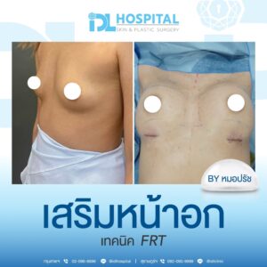 เสริมหน้าอก