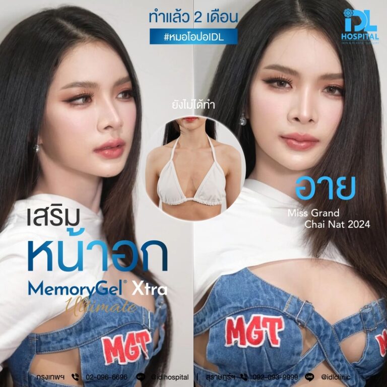 รีวิว เสริมหน้าอก