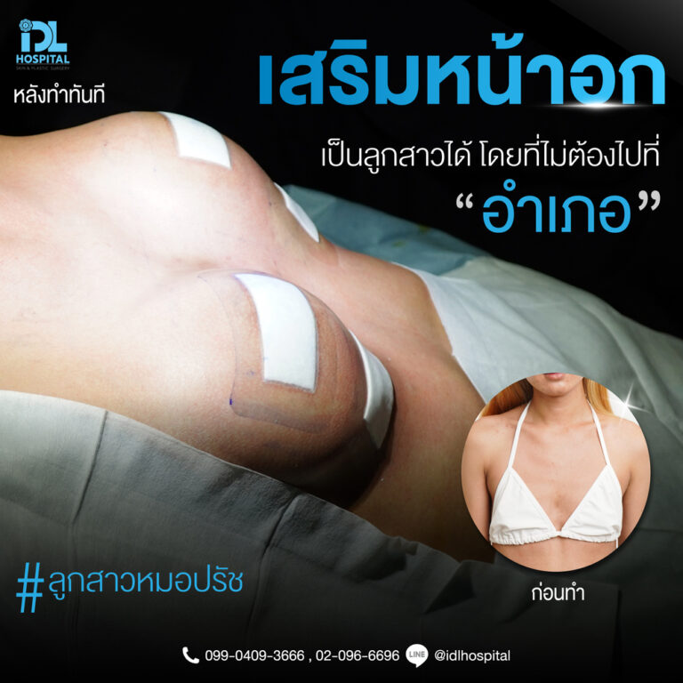 รีวิว เสริมหน้าอก