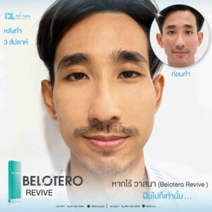 Filler Belotero Revive
