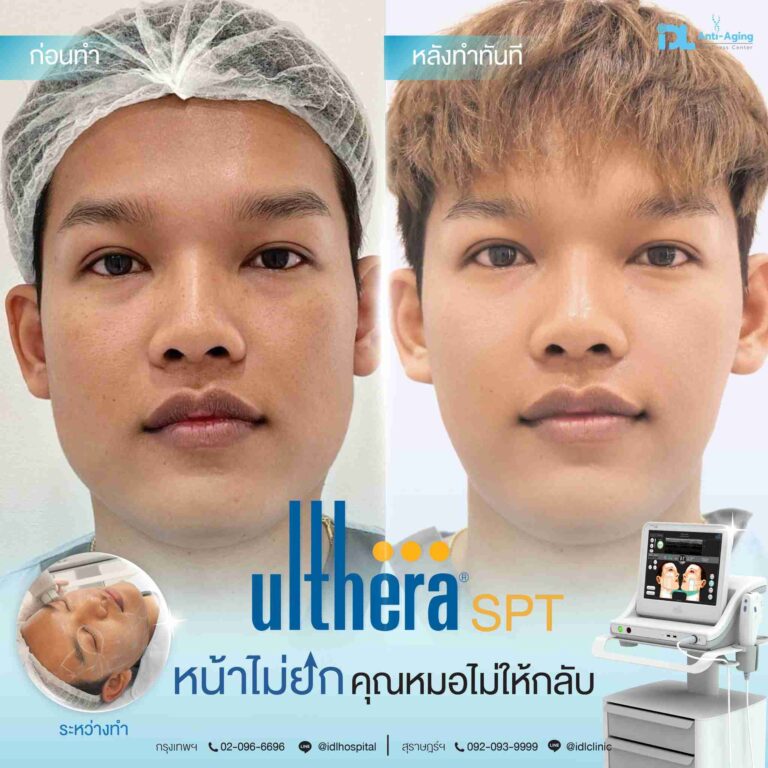 review ulthera