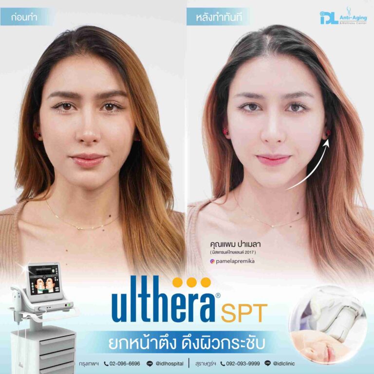 review ulthera