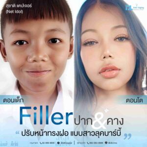 Filler