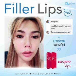 Filler Belotero lip