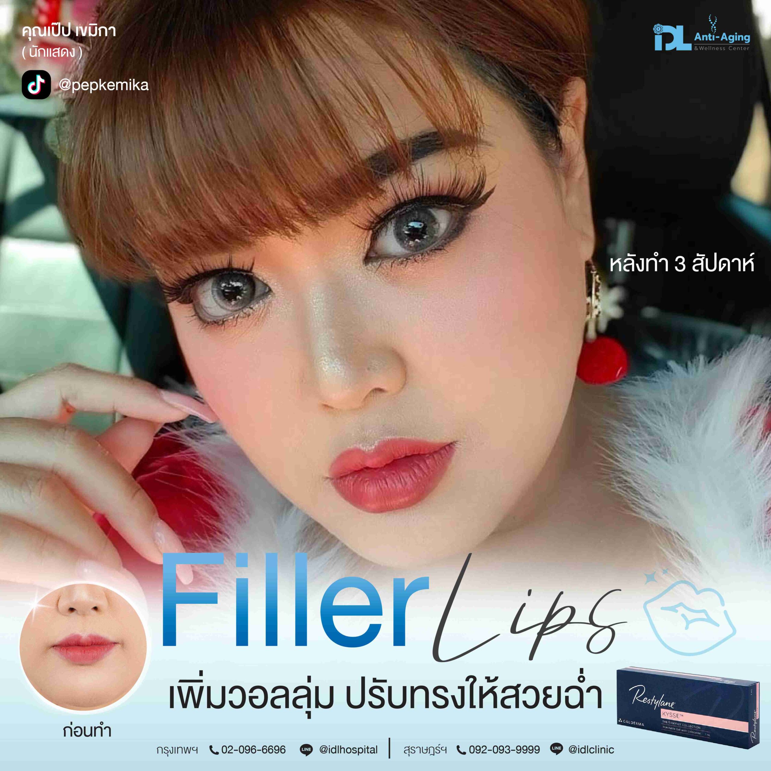 Filler Lips เพิ่มวอลลุ่ม