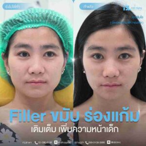 Filler