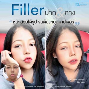 Filler
