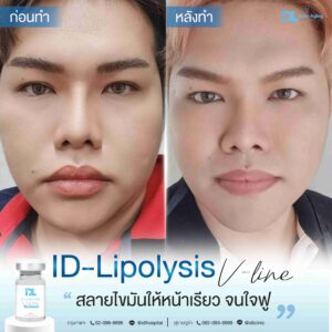 lipo